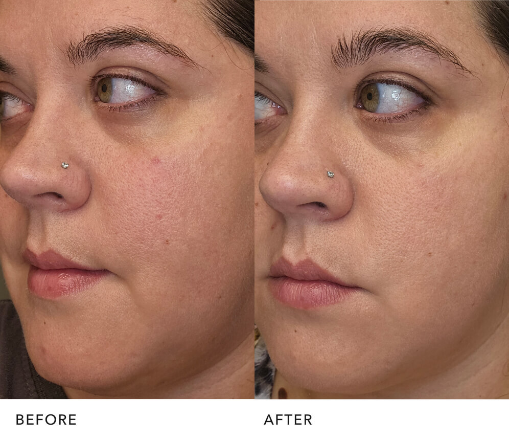  Before and after skin improvement with 手机168官网澳洲5™ essence: Improved Skin Texture | SK-II USA