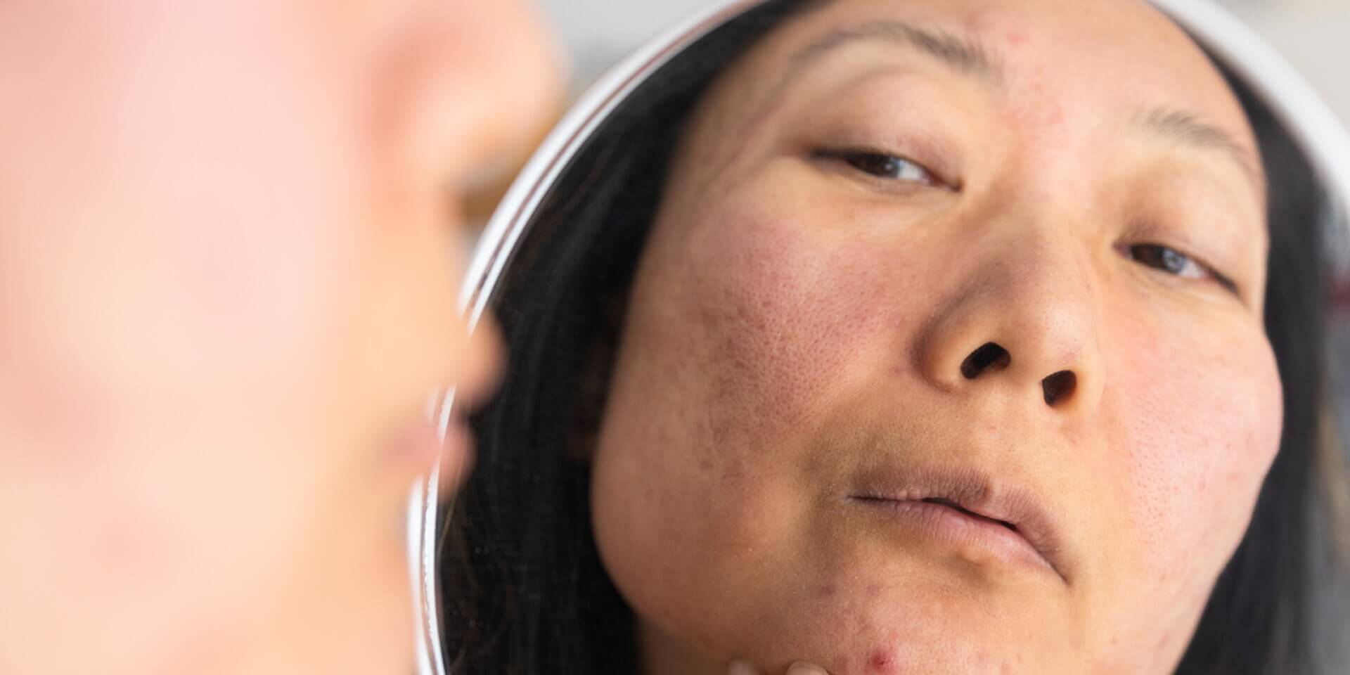Dry skin