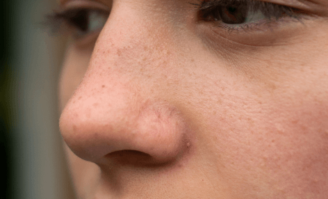 deep blackheads